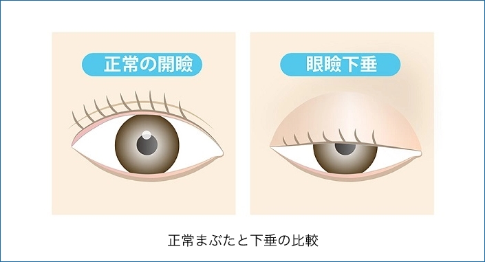 眼瞼下垂症の説明画像1