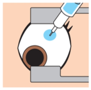 硝子体注射治療の説明画像
