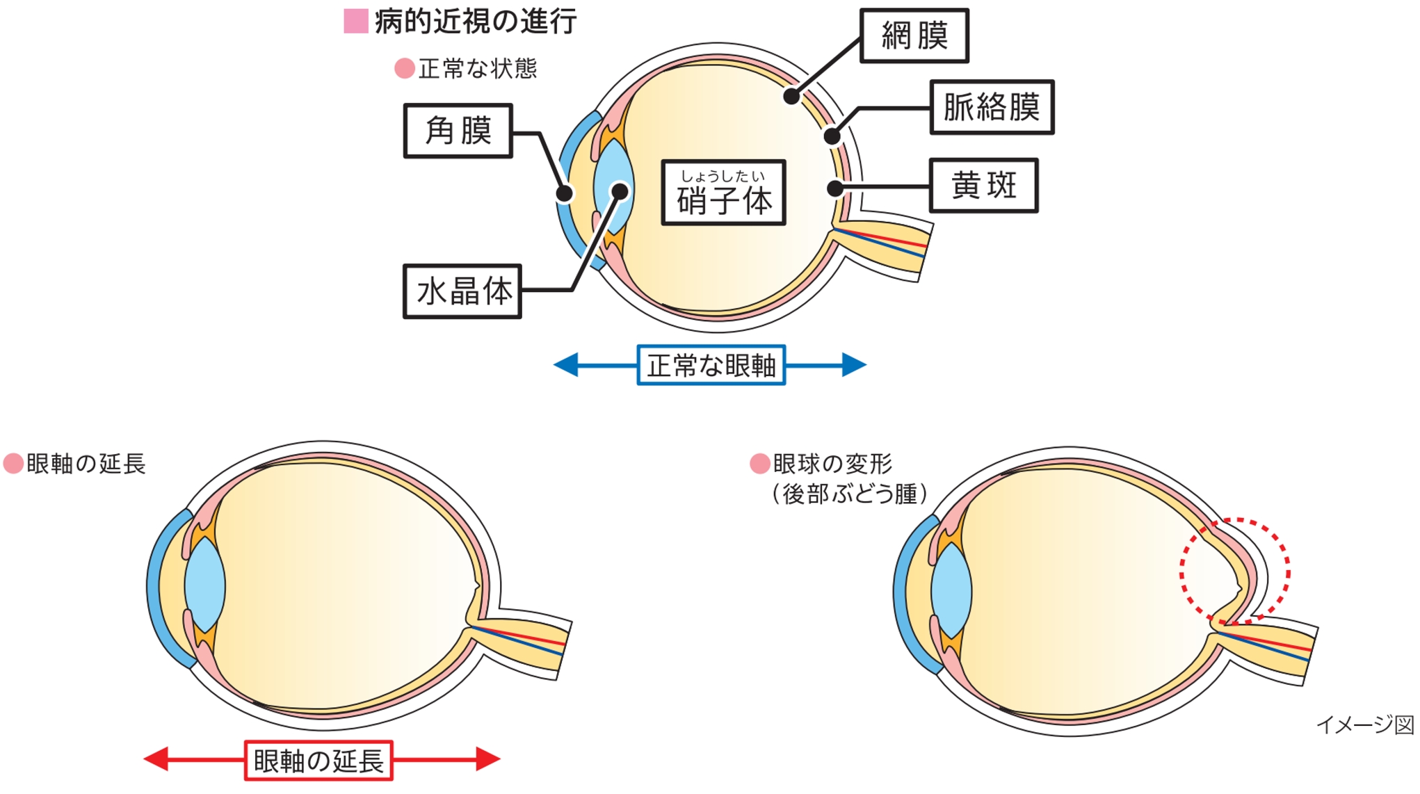 病的近視における脈絡膜新生血管の説明画像