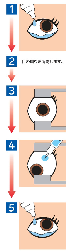 硝子体注射の方法の説明画像